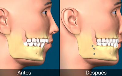 Cirugía mandibular correctiva