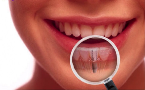 Cirugía de implantes dentales